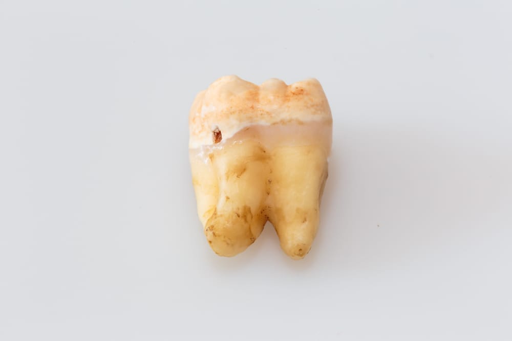Rotten And Dirty Tooth