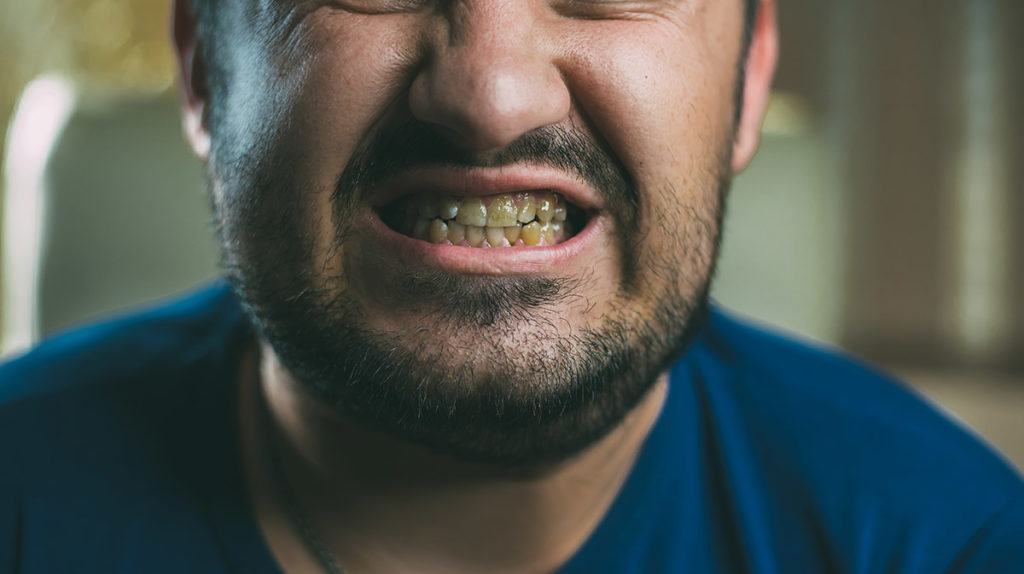 a man bares his teeth to show meth effects on teeth