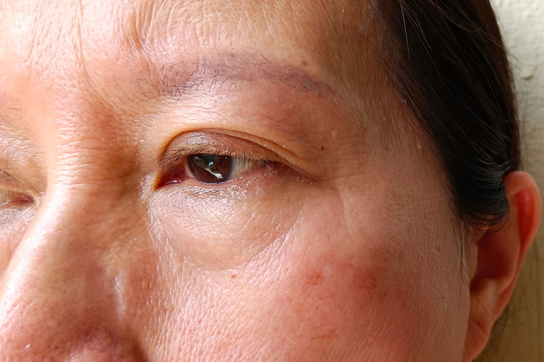 What Are Alcoholic Eyes? Alcohol Addiction Treatment